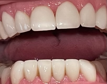 Veneers 3 after