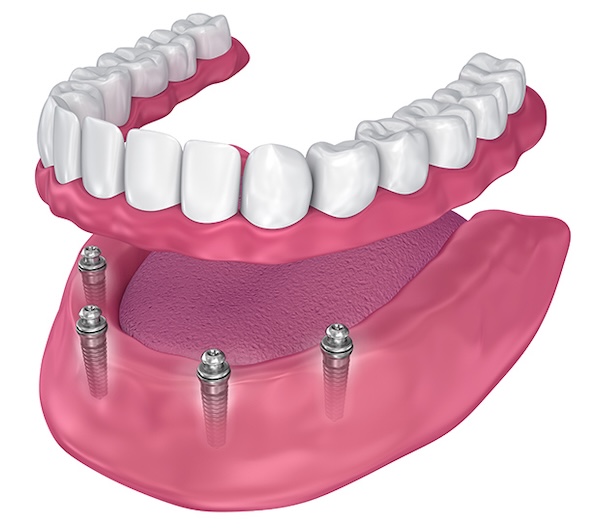 All-on-4 Implants in Staten Island, NY