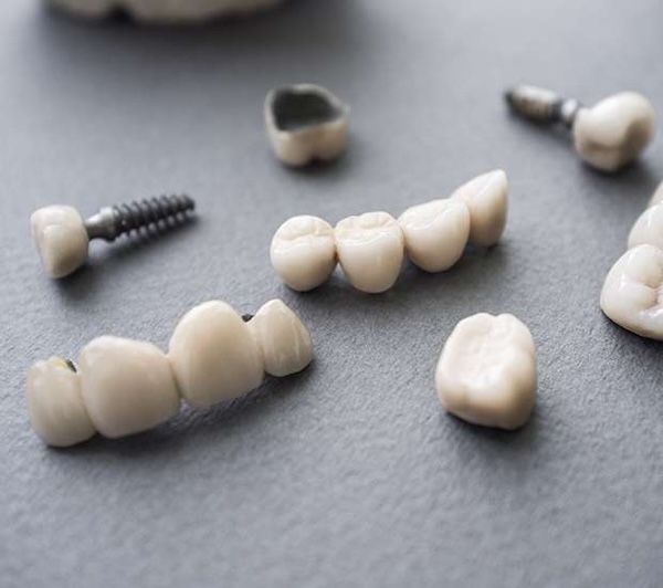 Implants vs. Mini Implants in Staten Island, NY