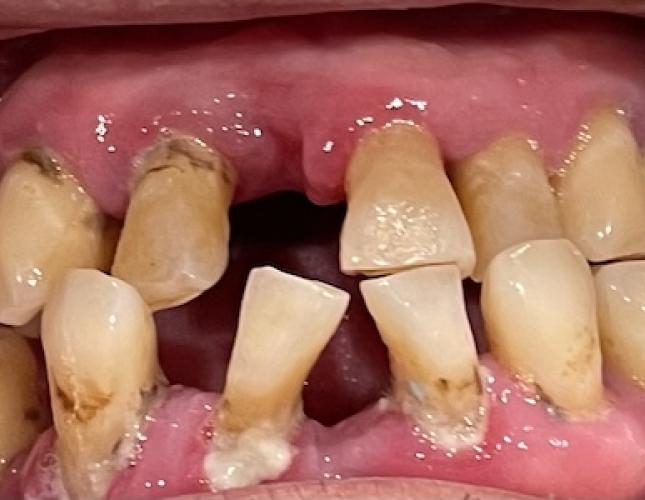 All-on-6 Implants before