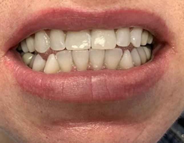 Teeth Whitening after