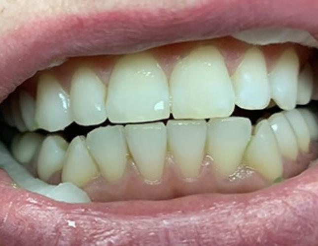 Teeth Whitening before
