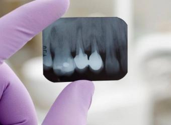Gemination and Fusion: Unusual Tooth Development Anomalies Explained